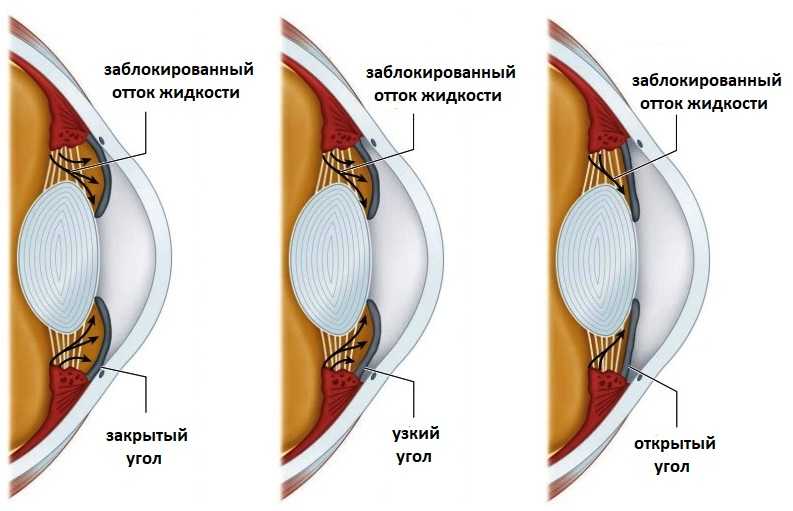 первичная закрытоугольная глаукома
