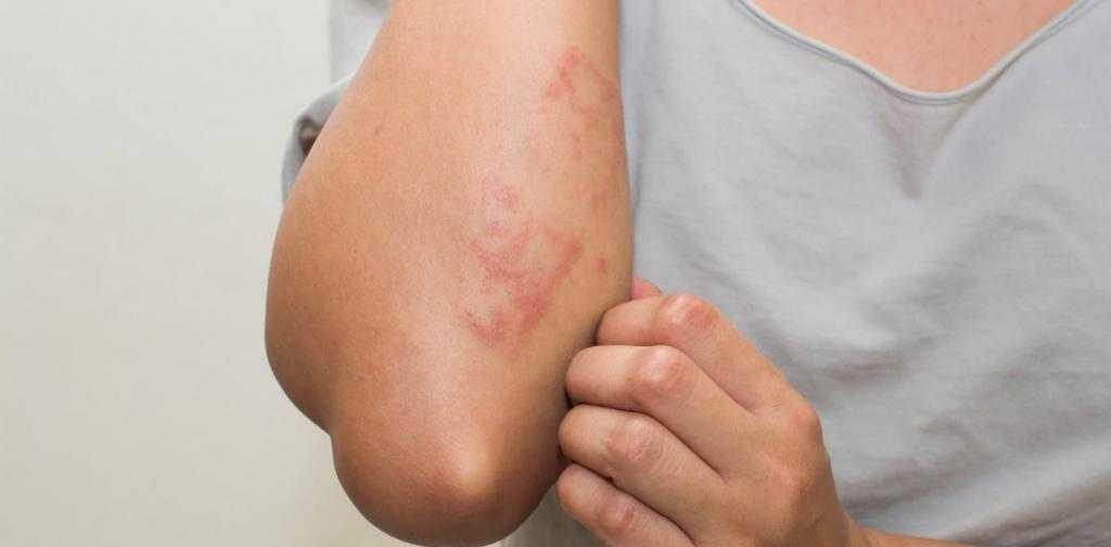 Аллергия на имбирь - кожные высыпания