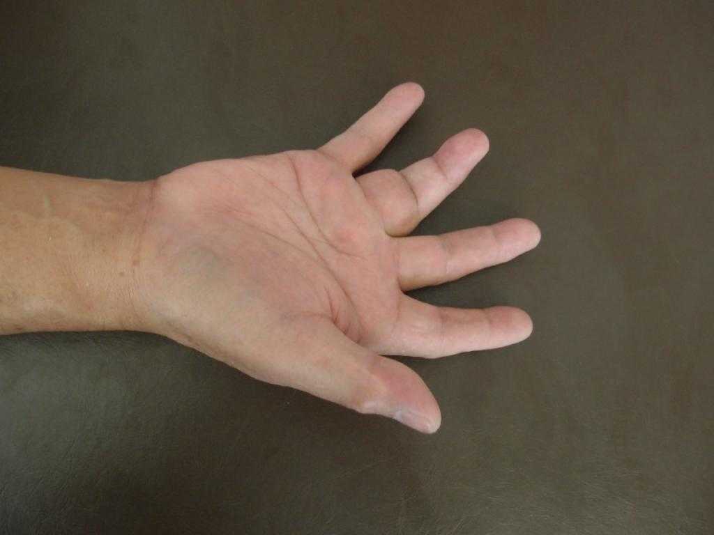 рак кожи на пальце фото