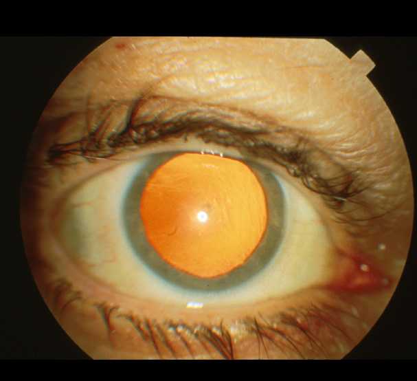 офтальмоскопия глазного дна как проводится