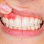 Удаляют ли зуб при флюсе: особенности ситуации
