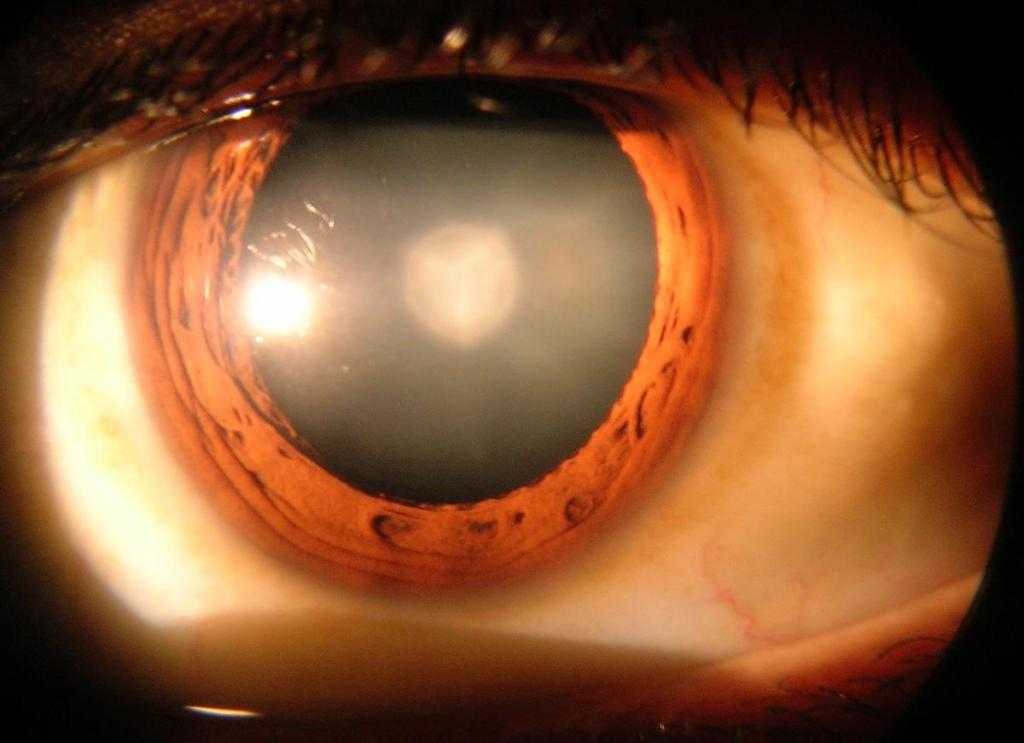 катаракта причины симптомы лечение
