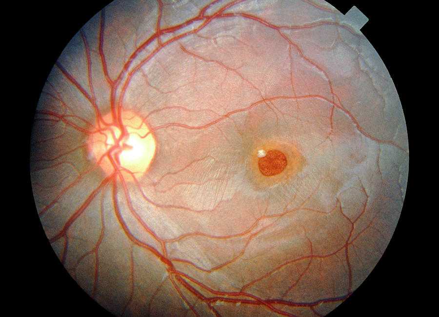 офтальмоскопия глазного дна виды