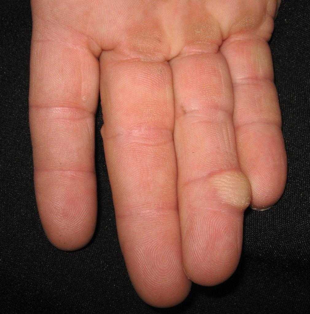 рак пальца руки симптомы