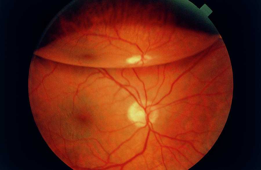 офтальмоскопия глазного дна это