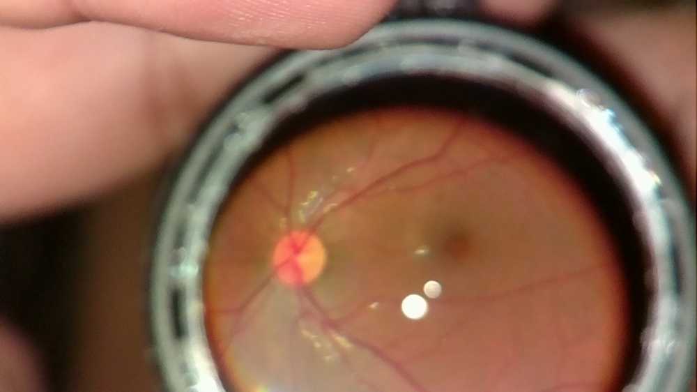 прямая офтальмоскопия глазного дна